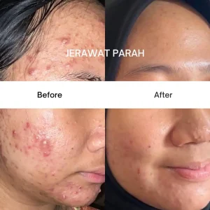 Acne-Berat.webp