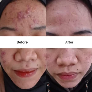 Jerawat-Parah.webp